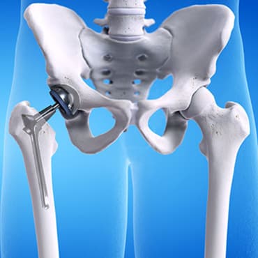 Total Hip Replacement-U/L